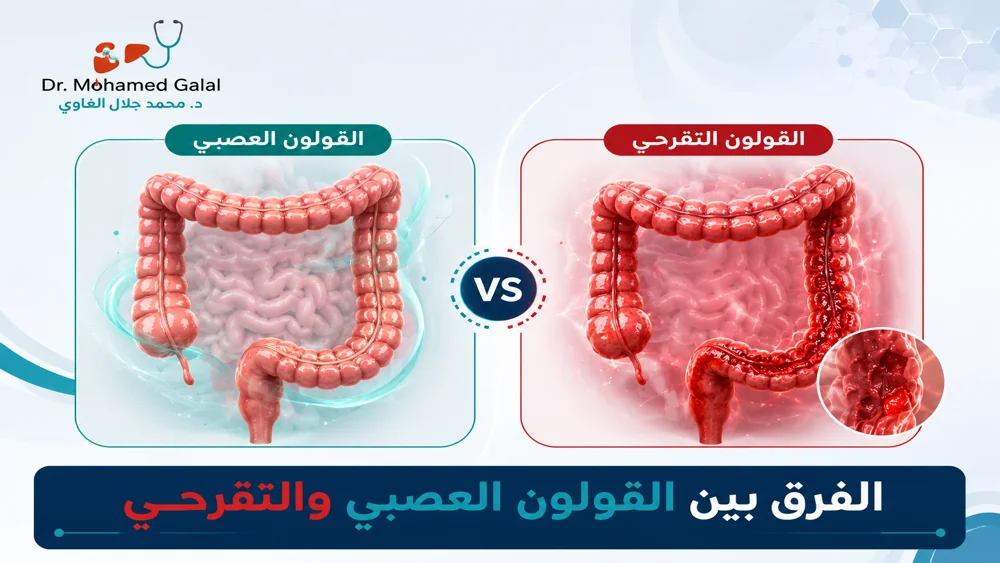 الفرق بين القولون العصبي والتقرحي بشكل واضح
