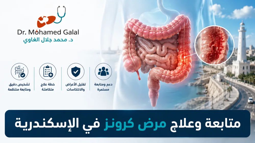 متابعة وعلاج مرض كرونز في الإسكندرية